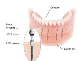 Dental implant jawbone graft