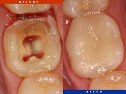Teeth brush very carefully but still got tooth decay, why?